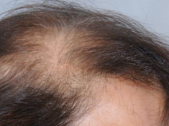 FUT Female Case 6 - Before