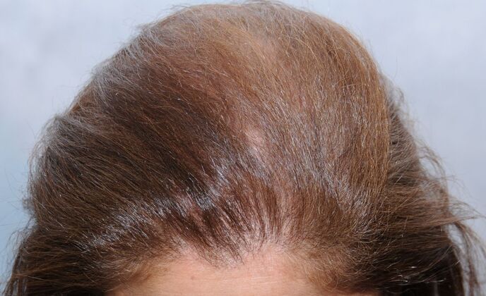 FUT Female: Case 6 - After