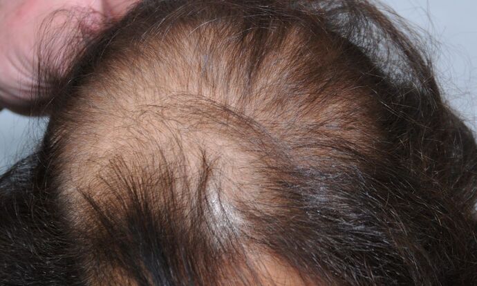 FUT Female: Case 6 - Before