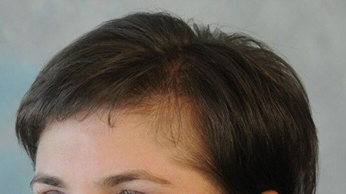 FUT Female: Case 7 - After