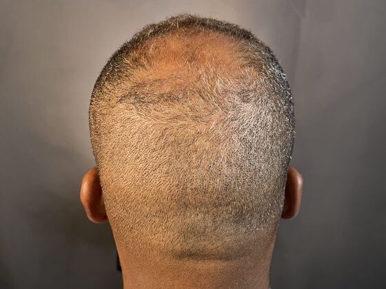 Ethnic Hair Restoration Case 3 - Before