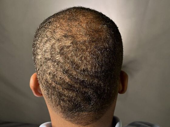 Ethnic Hair Restoration Case 3 - After