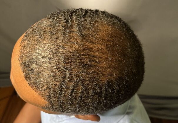 Ethnic Hair Restoration: Case 3 - After