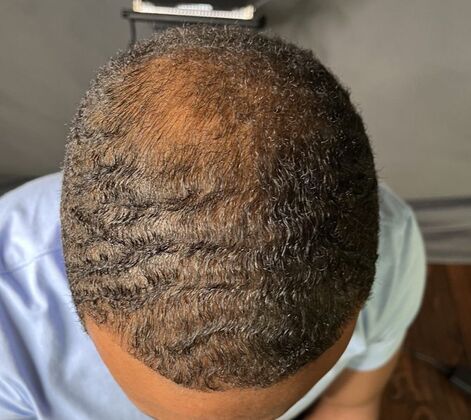 Ethnic Hair Restoration: Case 3 - After