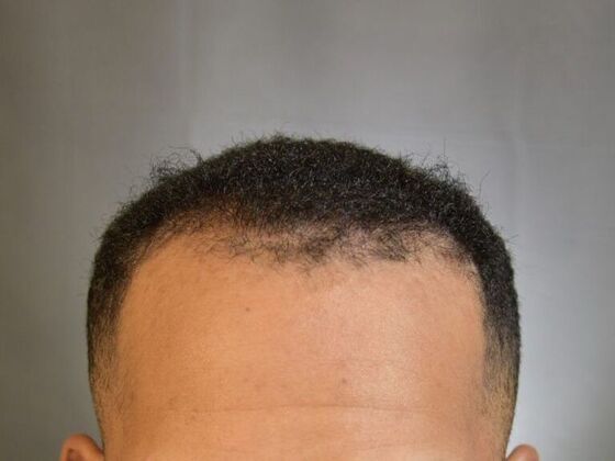 Ethnic Hair Restoration Case 4 - Before