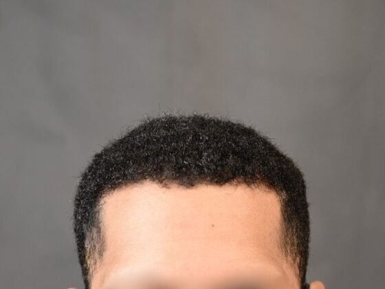 Ethnic Hair Restoration Case 4 - After