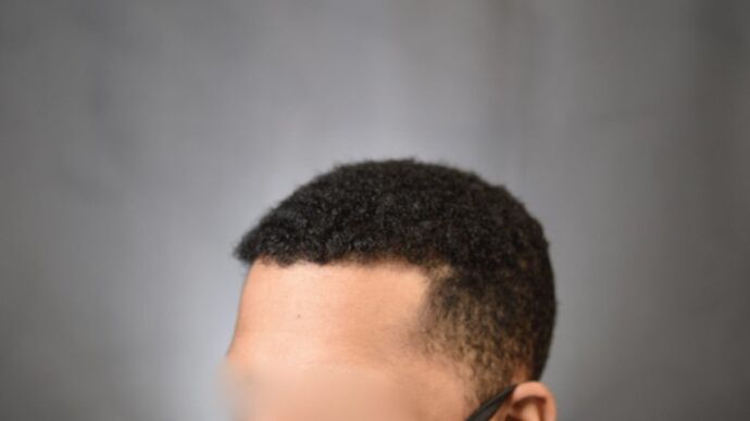 Ethnic Hair Restoration: Case 4 - After