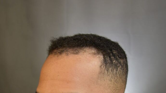 Ethnic Hair Restoration: Case 4 - Before