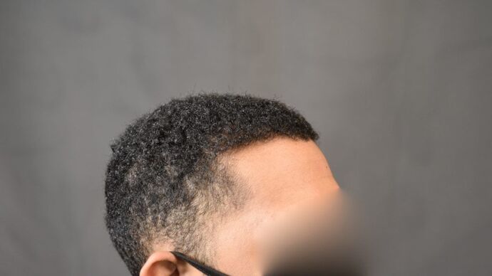 Ethnic Hair Restoration: Case 4 - After