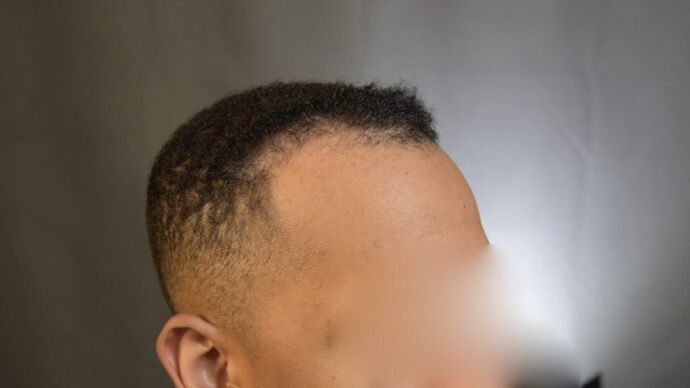 Ethnic Hair Restoration: Case 4 - Before