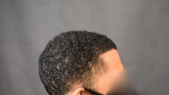 Ethnic Hair Restoration: Case 4 - After