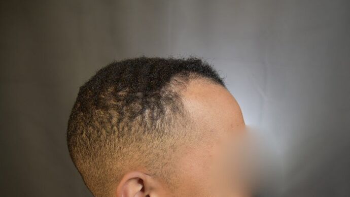 Ethnic Hair Restoration: Case 4 - Before
