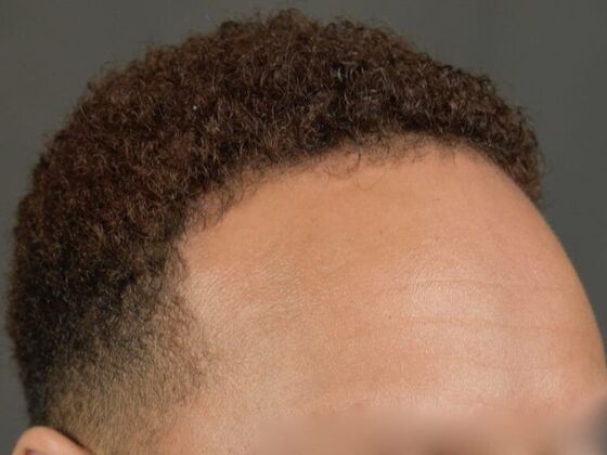 Ethnic Hair Restoration Case 5 - After