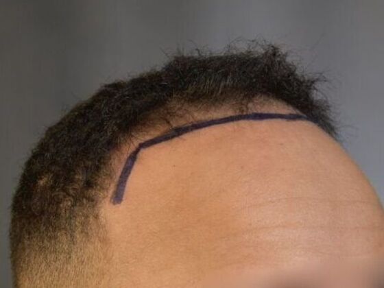 Ethnic Hair Restoration Case 5 - Before
