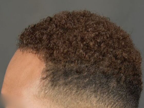 Ethnic Hair Restoration: Case 5 - After