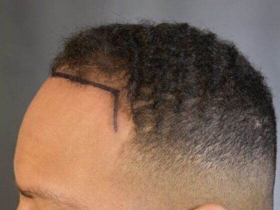 Ethnic Hair Restoration: Case 5 - Before