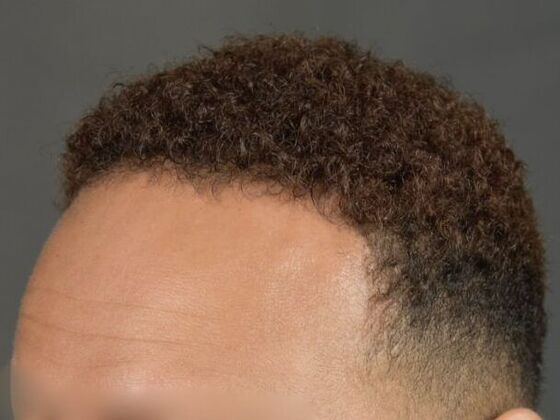 Ethnic Hair Restoration: Case 5 - After