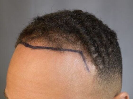 Ethnic Hair Restoration: Case 5 - Before