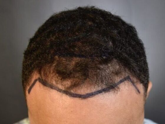 Ethnic Hair Restoration: Case 5 - Before