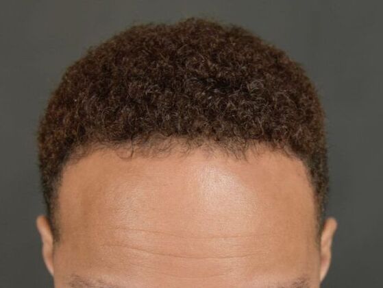 Ethnic Hair Restoration: Case 5 - After