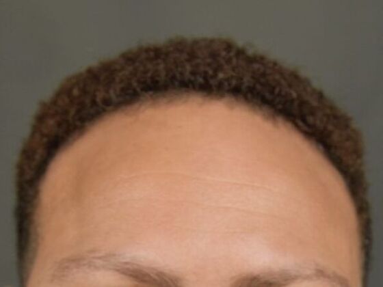 Ethnic Hair Restoration: Case 5 - After
