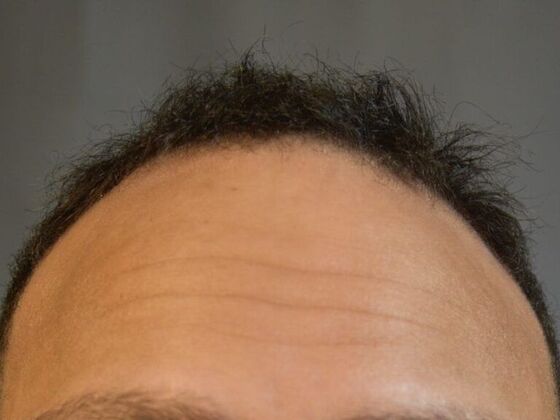 Ethnic Hair Restoration: Case 5 - Before