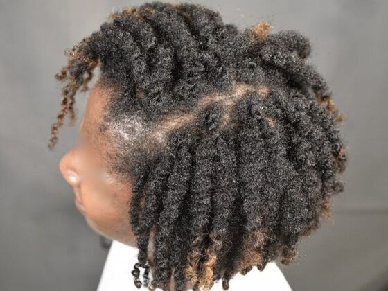 Ethnic Hair Restoration: Case 6 - After