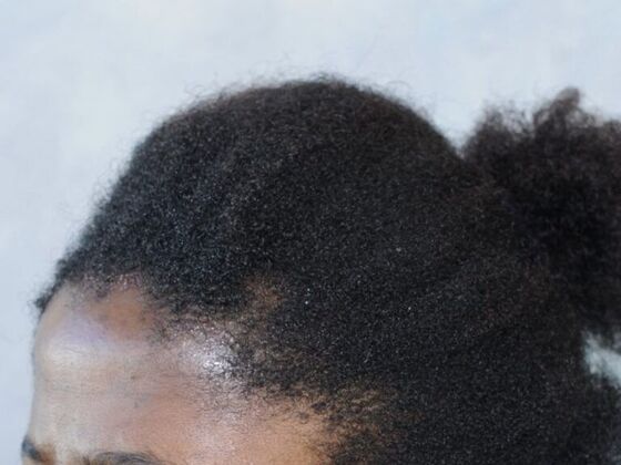 Ethnic Hair Restoration: Case 6 - Before