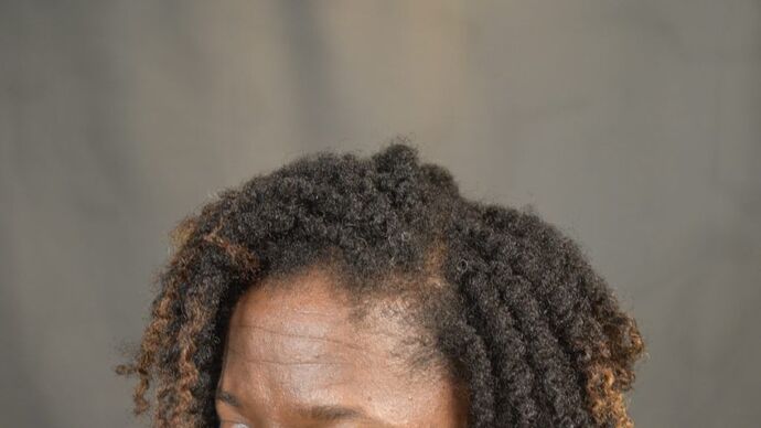 Ethnic Hair Restoration: Case 6 - After