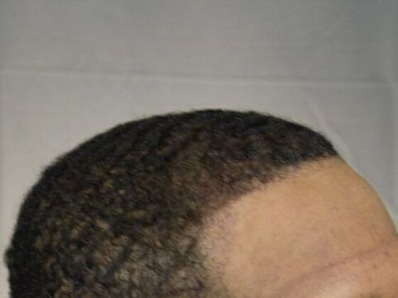 Ethnic Hair Restoration: Case 7 - After