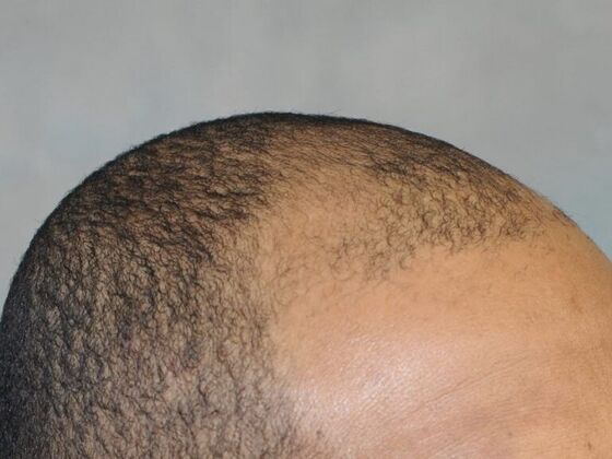 Ethnic Hair Restoration: Case 7 - Before