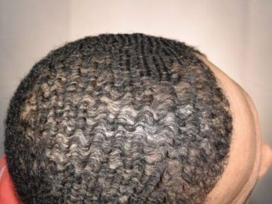 Ethnic Hair Restoration: Case 7 - After