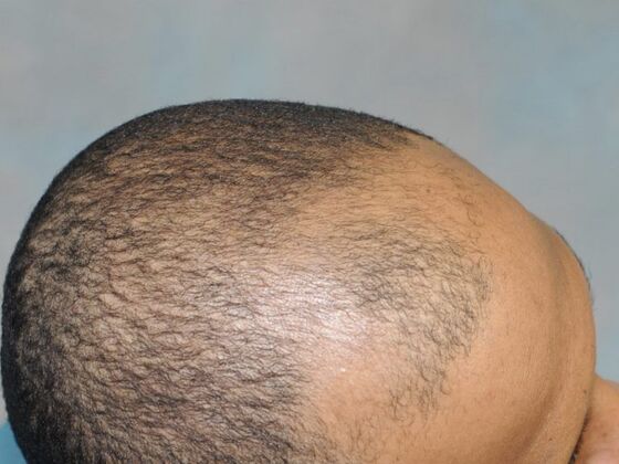 Ethnic Hair Restoration: Case 7 - Before