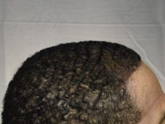 Ethnic Hair Restoration: Case 7 - After