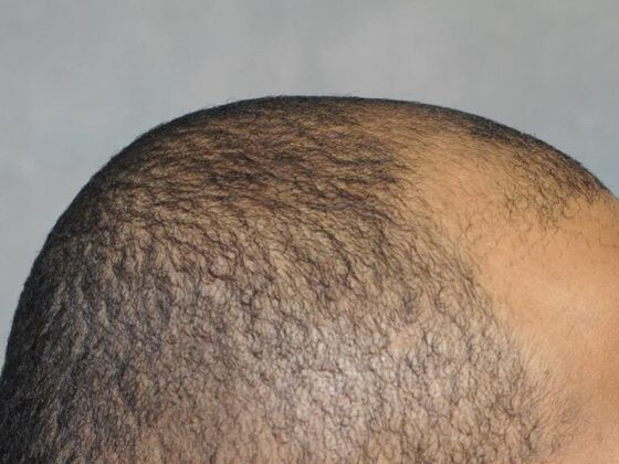 Ethnic Hair Restoration: Case 7 - Before