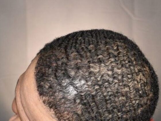 Ethnic Hair Restoration: Case 7 - After