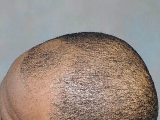 Ethnic Hair Restoration: Case 7 - Before