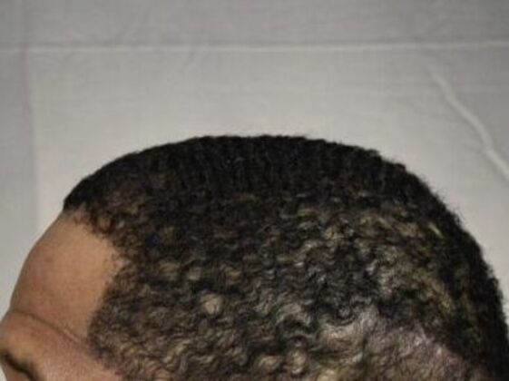Ethnic Hair Restoration: Case 7 - After