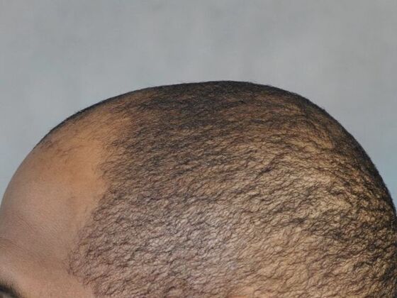 Ethnic Hair Restoration: Case 7 - Before
