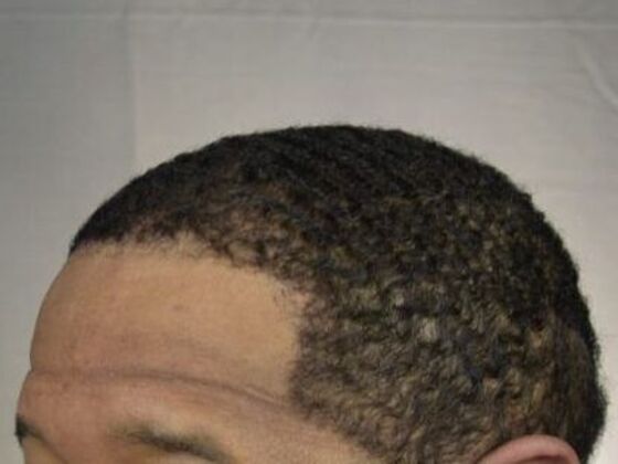 Ethnic Hair Restoration: Case 7 - After