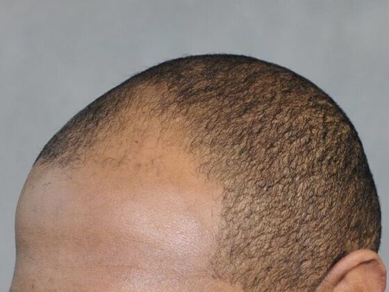 Ethnic Hair Restoration: Case 7 - Before