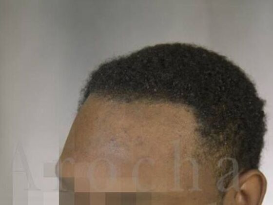 Ethnic Hair Restoration: Case 8 - After