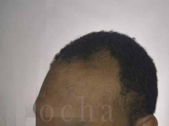 Ethnic Hair Restoration: Case 8 - Before