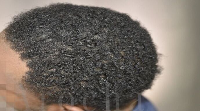 Ethnic Hair Restoration: Case 8 - After