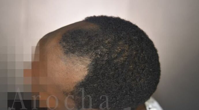 Ethnic Hair Restoration: Case 8 - Before