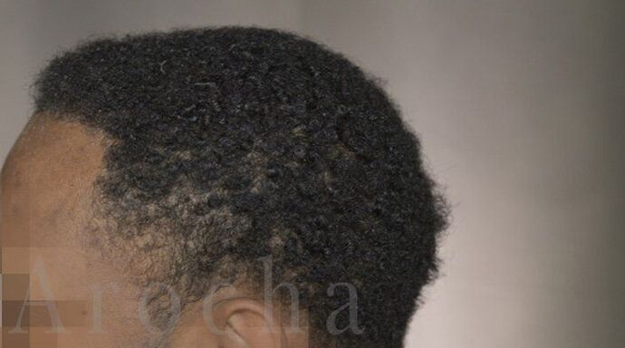 Ethnic Hair Restoration: Case 8 - After