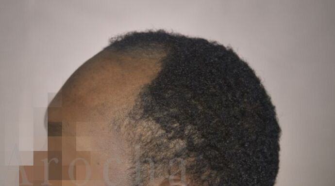 Ethnic Hair Restoration: Case 8 - Before