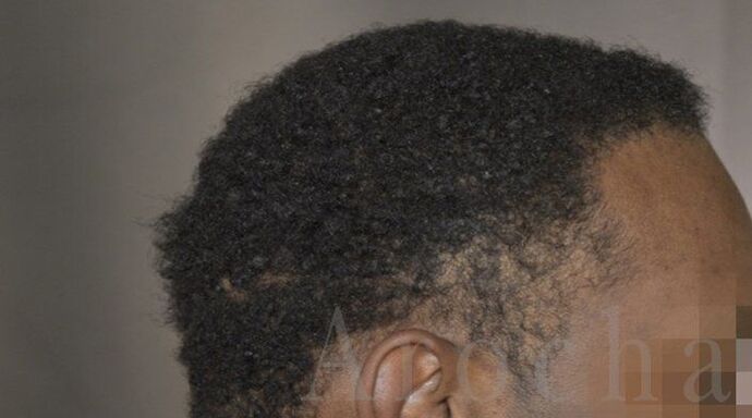 Ethnic Hair Restoration: Case 8 - After