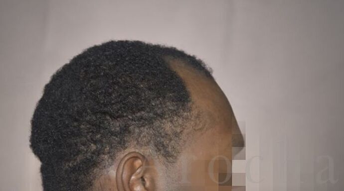 Ethnic Hair Restoration: Case 8 - Before