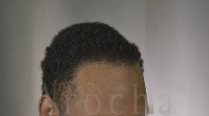 Ethnic Hair Restoration: Case 8 - After